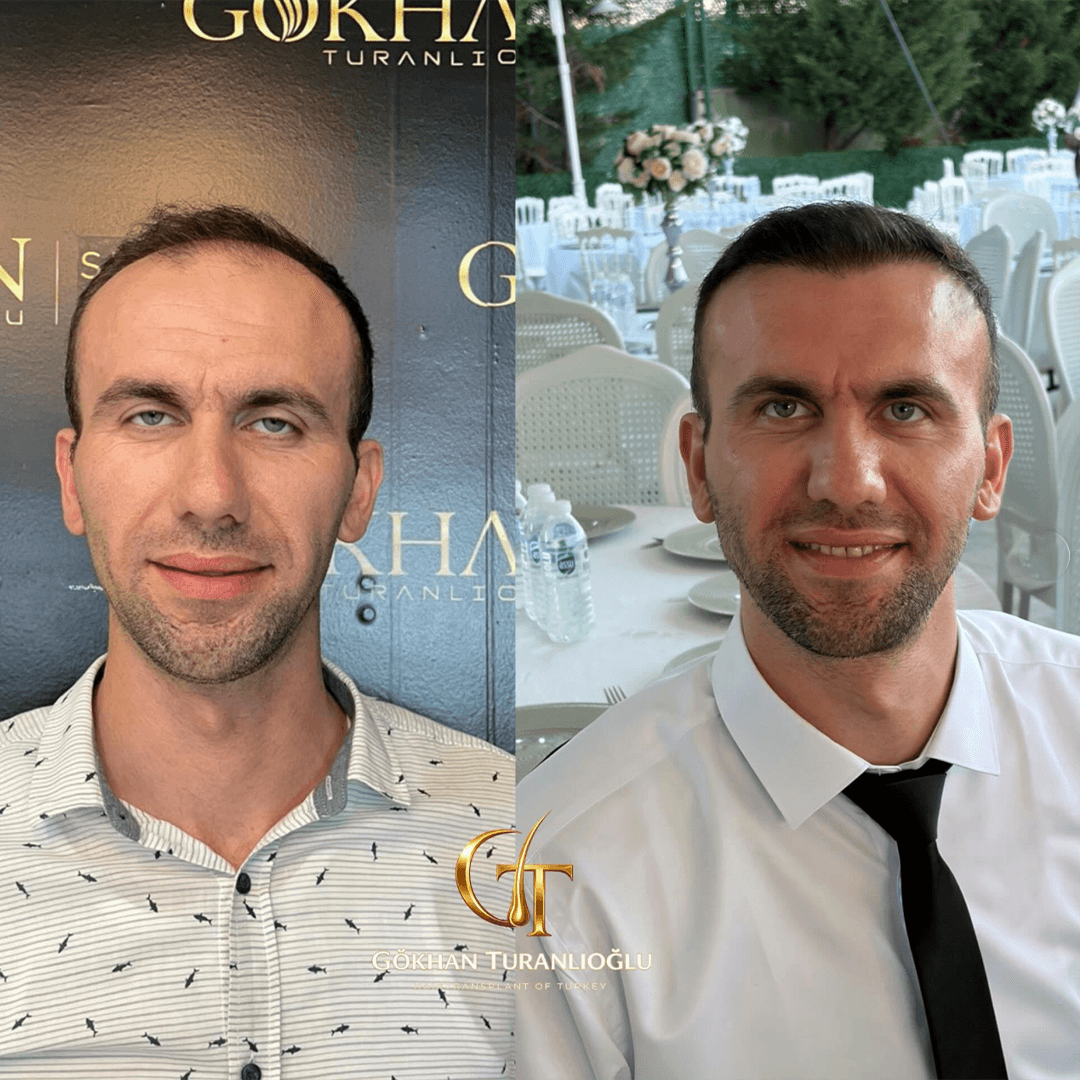 Saç ekimi öncesi ve sonrası — sonuç 2