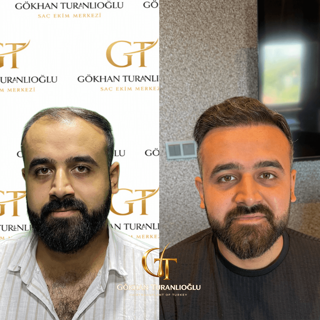Saç ekimi öncesi ve sonrası — sonuç 3