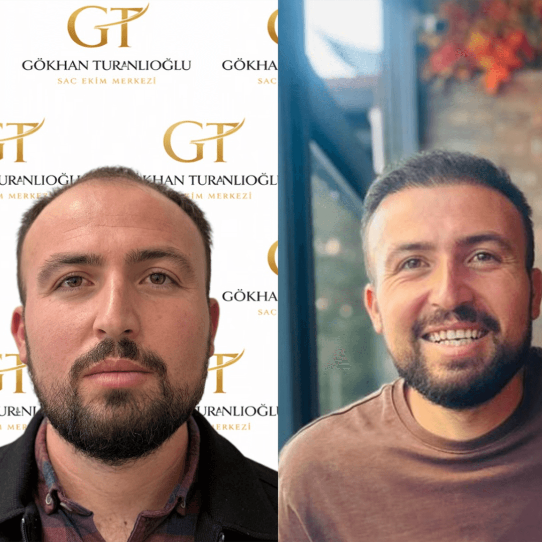 Saç ekimi öncesi ve sonrası — sonuç 4