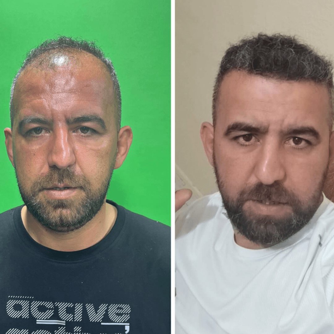 Saç ekimi öncesi ve sonrası — sonuç 5